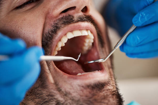 Best Emergency Wisdom Tooth Extraction in Dentsville, SC